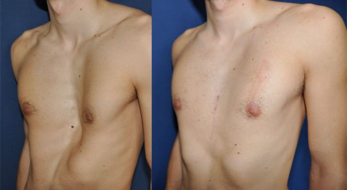 Ths Bs Tr N Thanh V Pectus Excavatum In Adults Ths. black kitchen with merm...