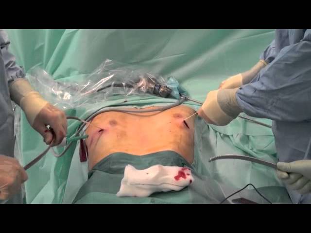 Surgical-Technique-Pectus-Excavatum