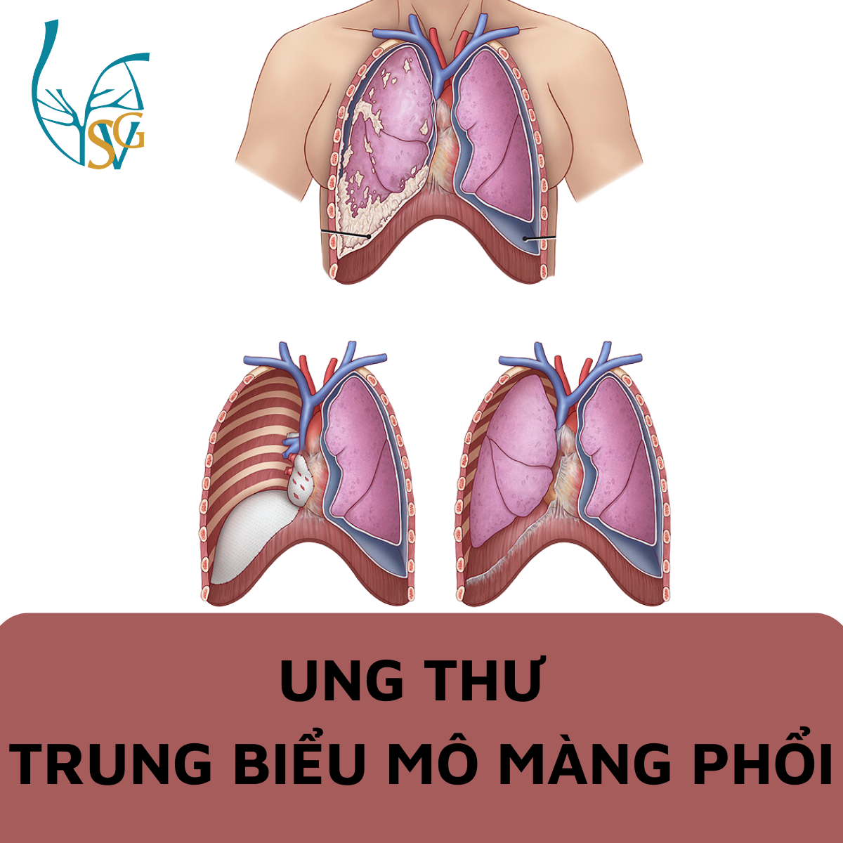 TS BS TRẦN THANH VỸ Cực nguy hiểm với căn bệnh Ung thư trung biểu mô