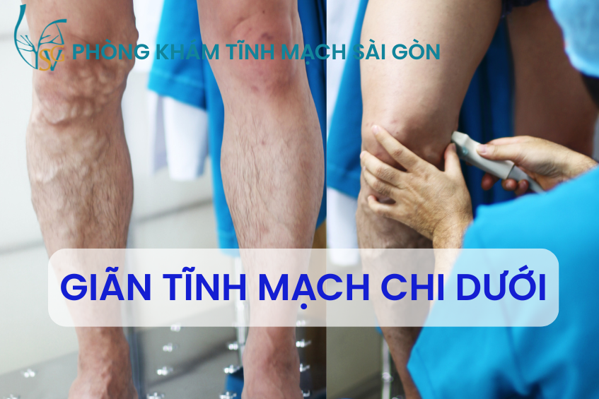 gian-tinh-mach-chi-duoi-bs-tran-thanh-vy