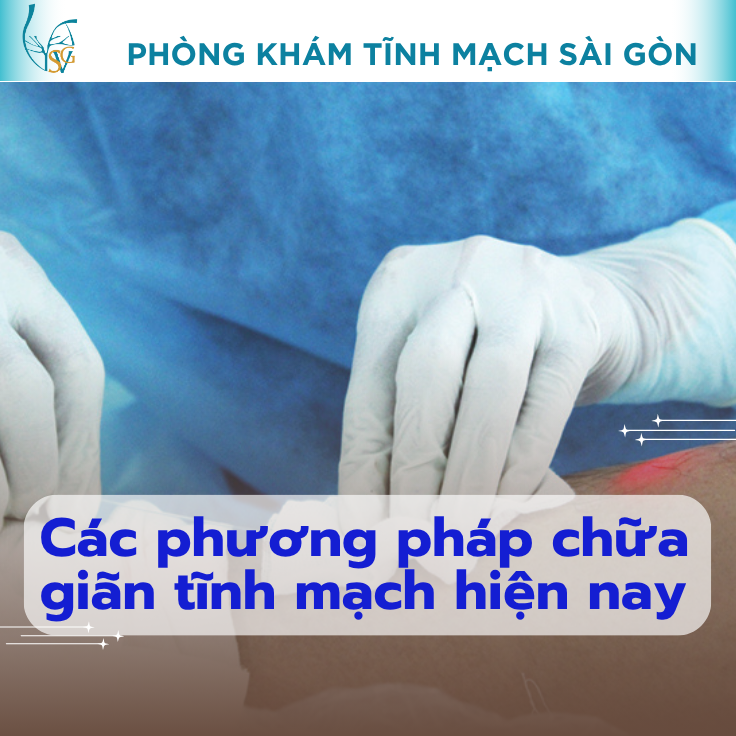 cac-phuong-phap-chua-gian-tinh-mach-hien-nay