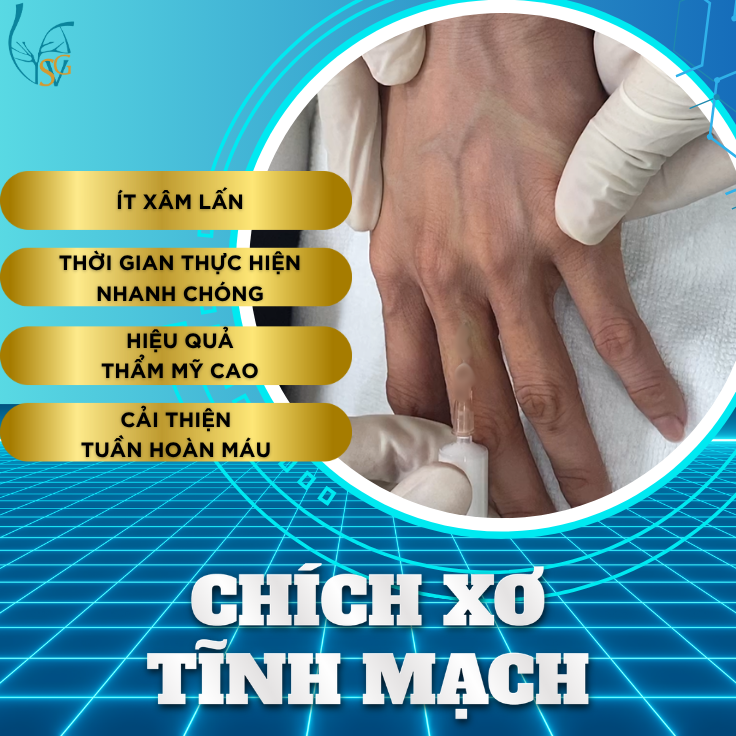 chua-gian-tinh-mach-chich-xo-tinh-mach