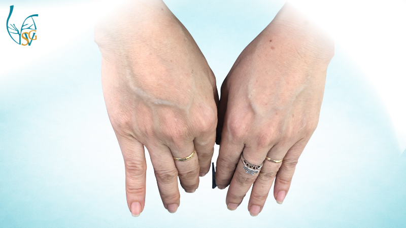 suy-gian-tinh-mach-tay