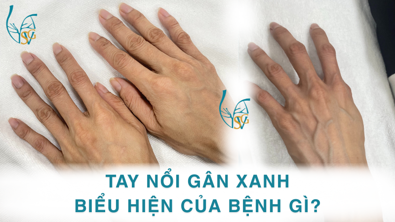 tay-noi-gan-xanh-bieu-hien-benh-gi